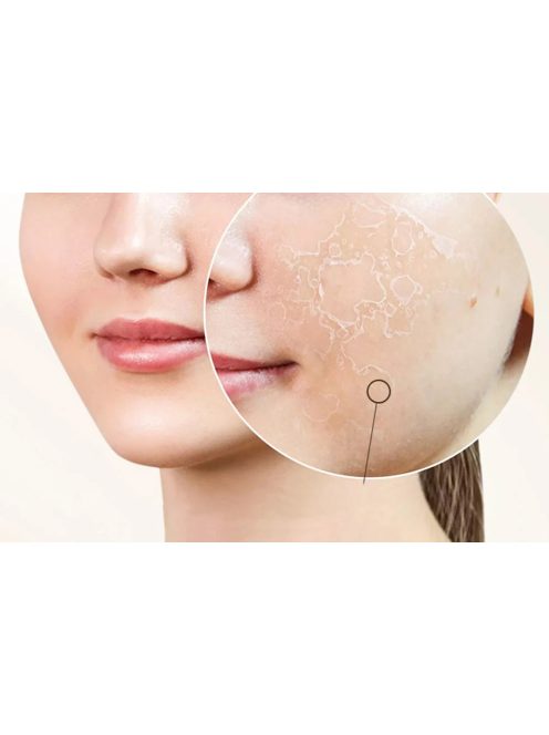 ANLAN 01-AVLY41-02A feszesítő arcápoló készülék